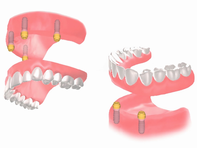 インプラント＋入れ歯という選択肢も