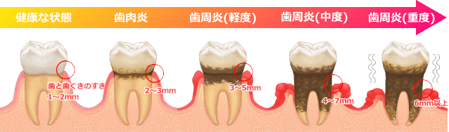 歯周病の進行について