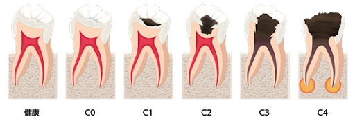 虫歯の進行状態・治療法